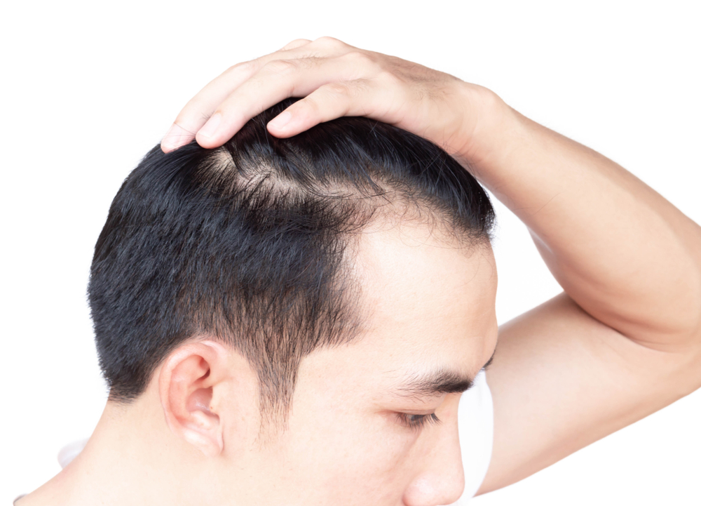 Hair Loss in Northern Virginia