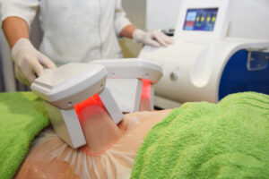 CoolSculpting McLean VA