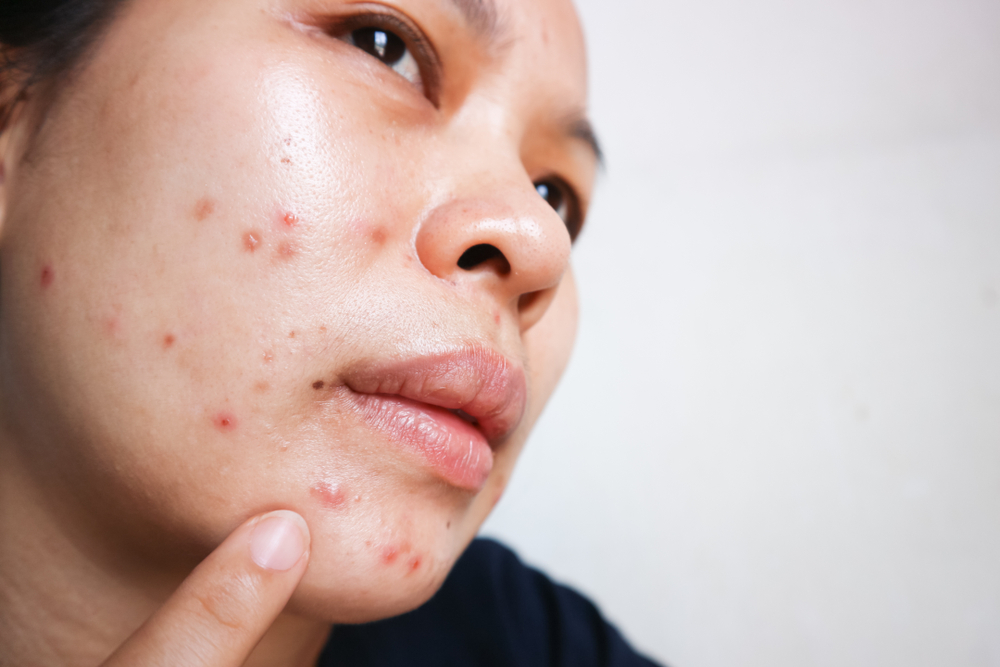 Cystic Acne