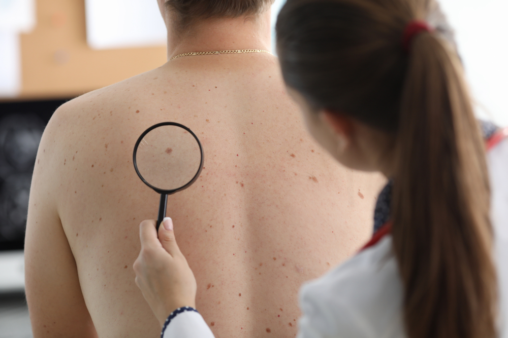 Cosmetic Mole Removal