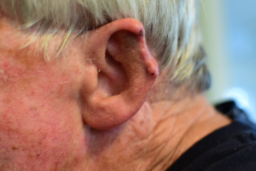 Skin Cancer Surgery