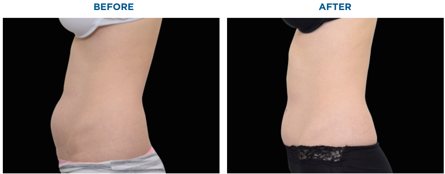 Toned Abs Treatment Northern Virginia