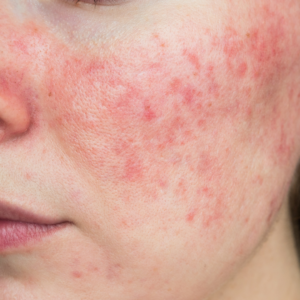 facial redness treatments