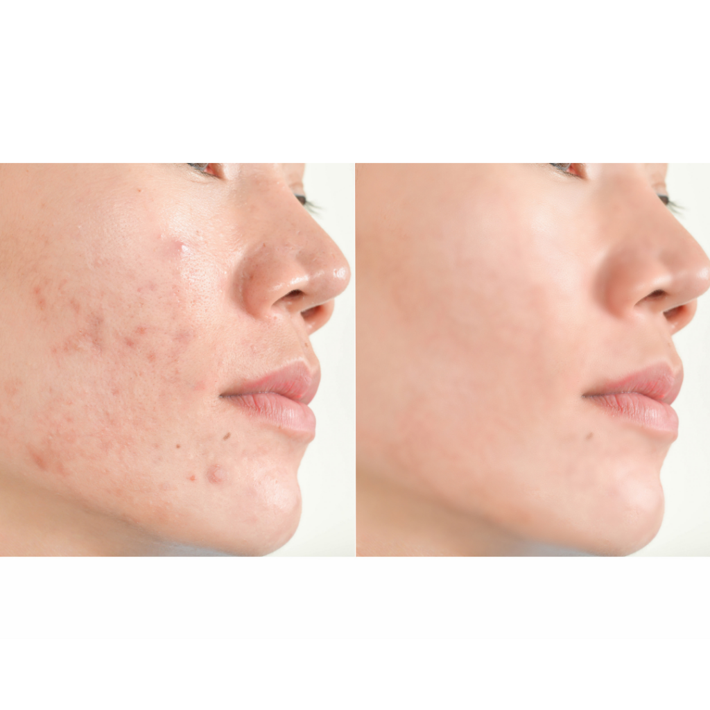 Top Holistic Acne Supplements