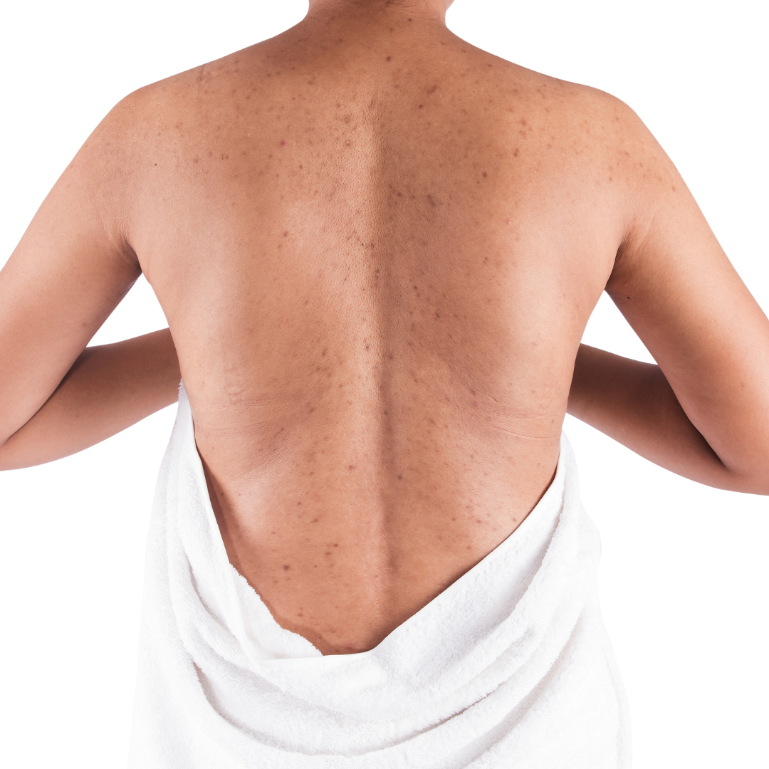 back and butt acne treatments