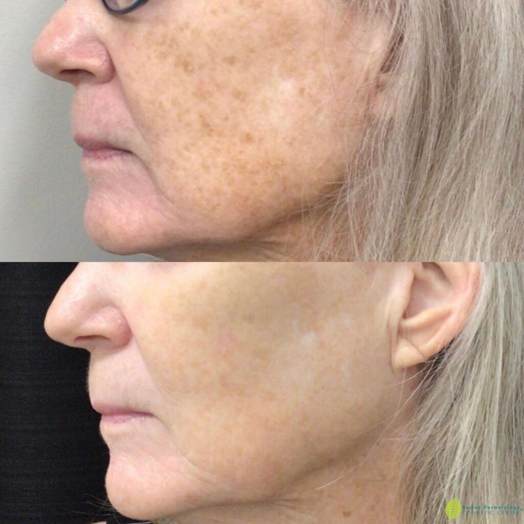 What is the Fastest Way to Get Rid of Age Spots?