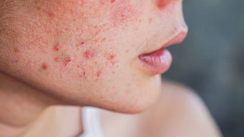 Alternatives to Accutane for Cystic Acne in Reston