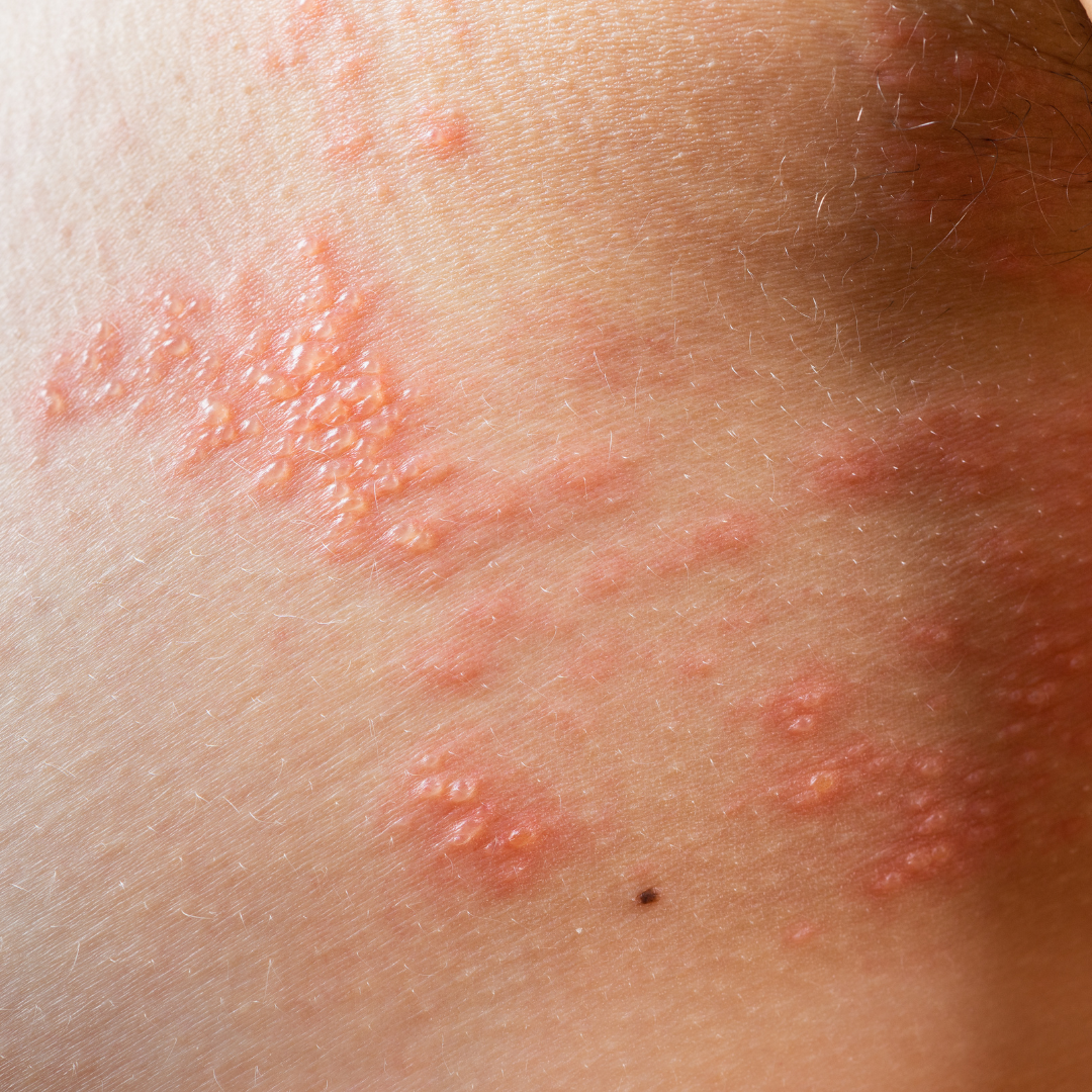 Same Day Dermatology Appointment Northern Virginia