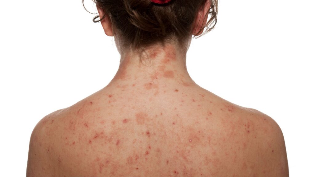 eczema specialist in Northern Virginia