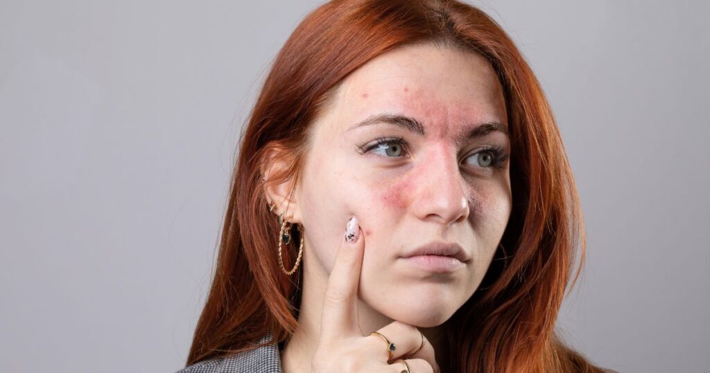 top rosacea treatments in Reston