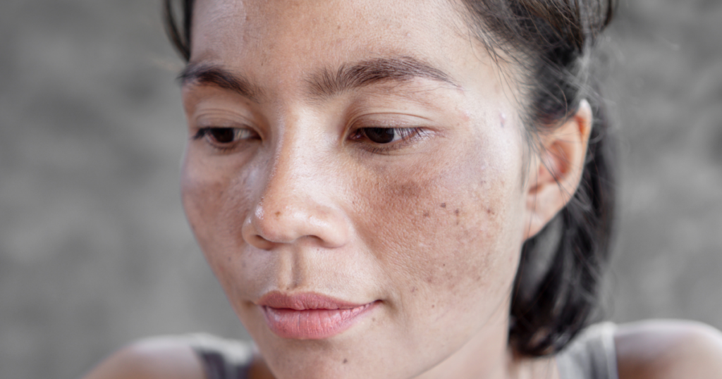 Melasma Treatments in Reston VA